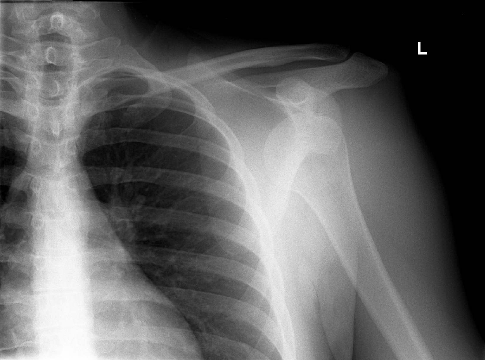 X Ray Shoulder Anatomy