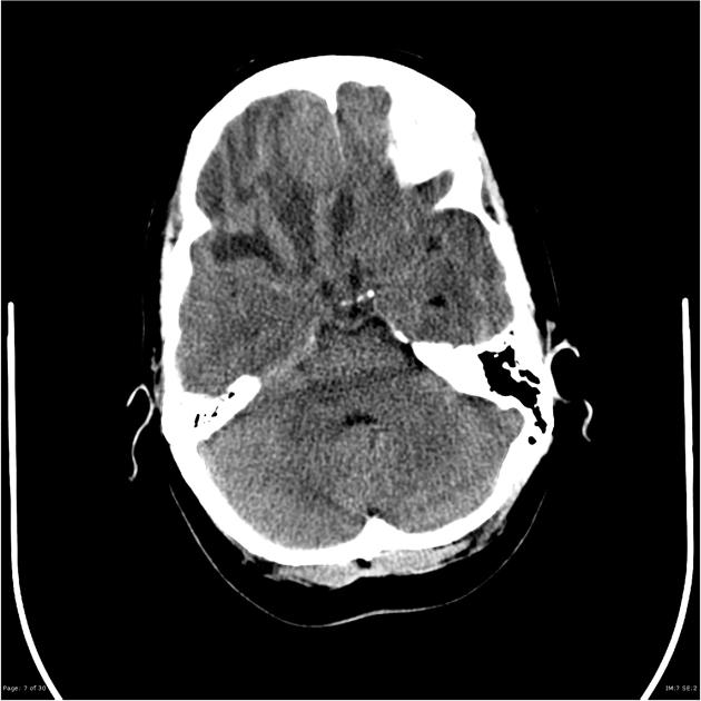 Meningioma | Radiology Case | Radiopaedia.org