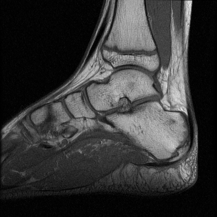 Intramuscular venous malformation of foot | Image | Radiopaedia.org