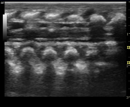 Normal neonatal spinal canal (ultrasound) | Image | Radiopaedia.org