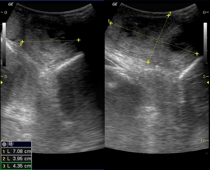 Epididymal Abscess Ultrasound