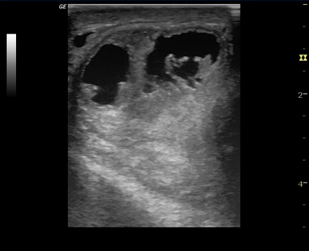 Epididymal Abscess Ultrasound