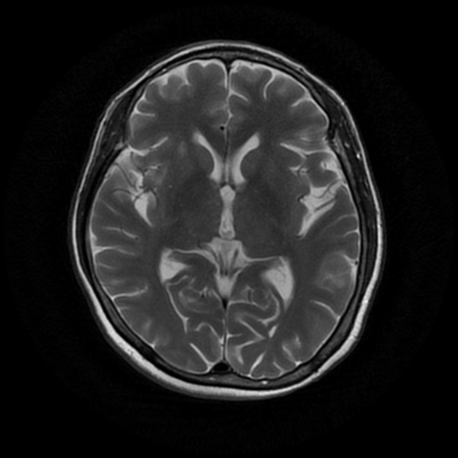 Cavernous dural arteriovenous fistula with cortical venous reflux ...