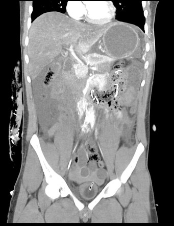 Gunshot wound and shock bowel | Image | Radiopaedia.org