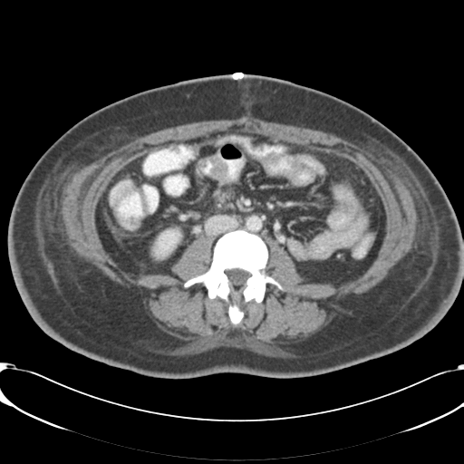 Shock bowel | Image | Radiopaedia.org