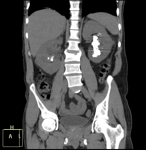 Emphysematous pyelitis with nephrolithiasis | Image | Radiopaedia.org