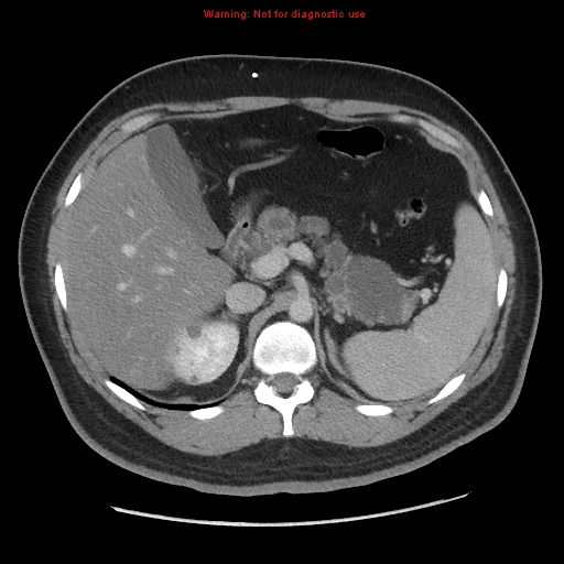 Von Hippel-Lindau disease | Image | Radiopaedia.org