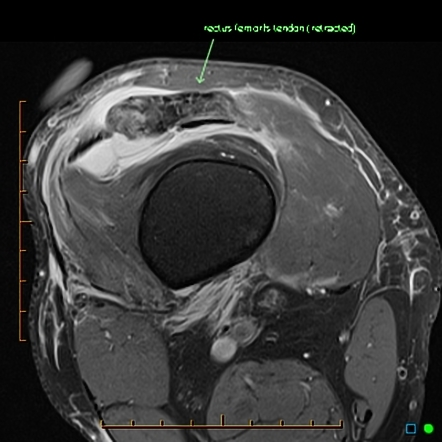 Rectus femoris tendon rupture | Image | Radiopaedia.org