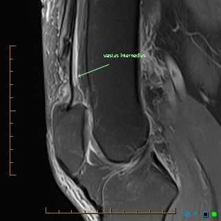 Rectus Femoris Tendon