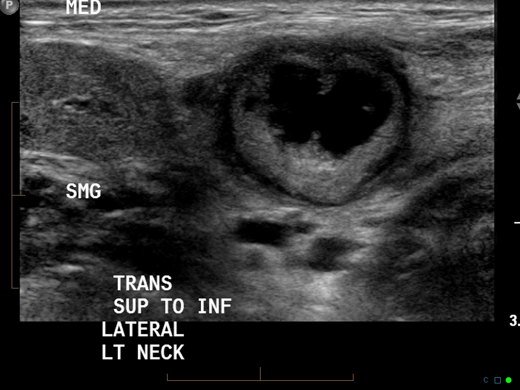 Metastatic Squamous Cell Carcinoma Neck Lymph Node Image 5705