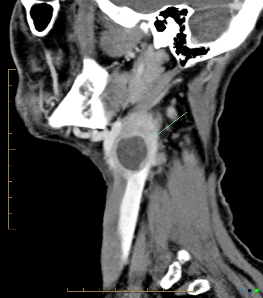 Metastatic Squamous Cell Carcinoma Neck Lymph Node Image 4192