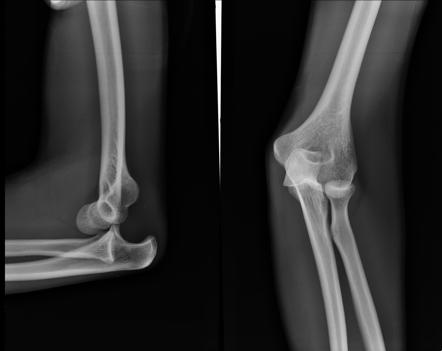 Elbow Dislocation Radiology Reference Article Radiopaedia Org