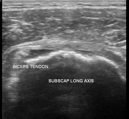 Rotator cuff tear | Radiology Reference Article | Radiopaedia.org