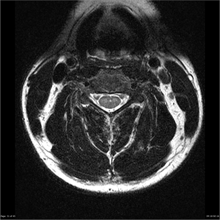 Owl-eyes sign (spinal cord) | Radiology Reference Article | Radiopaedia.org