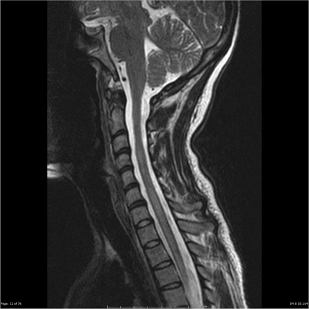 Neuromyelitis optica spectrum disorder | Radiology Reference Article ...