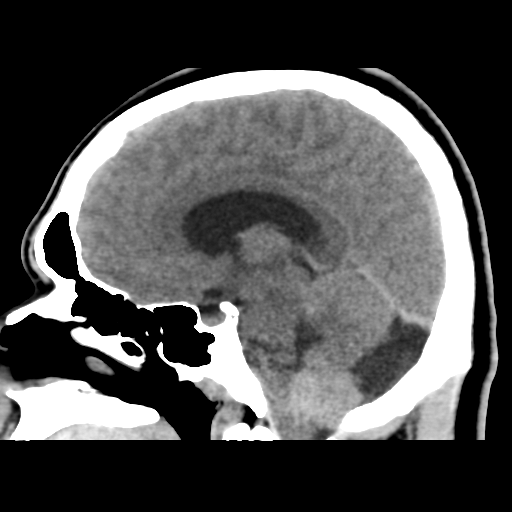 Choroid plexus papilloma | Image | Radiopaedia.org