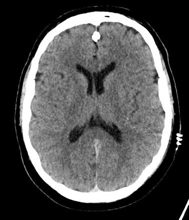 Post Op Cerebellar Venous Infarct | Radiology Case | Radiopaedia.org