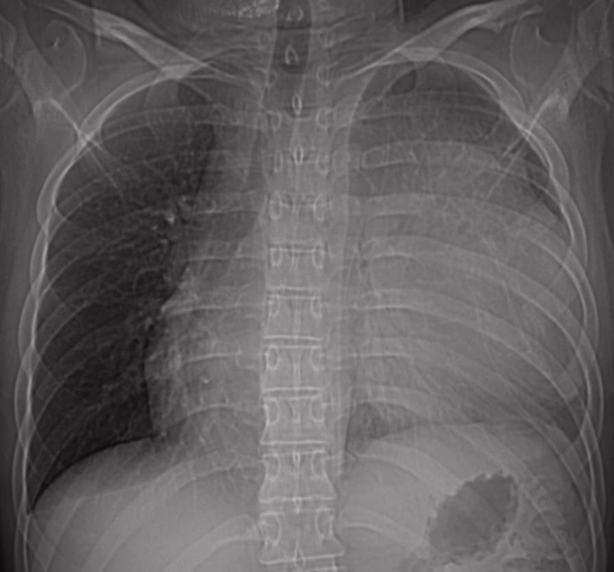 Mediastinal Germ Cell Tumor Staging