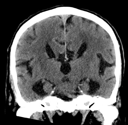 Colpocephaly and agenesis of the corpus callosum | Image | Radiopaedia.org