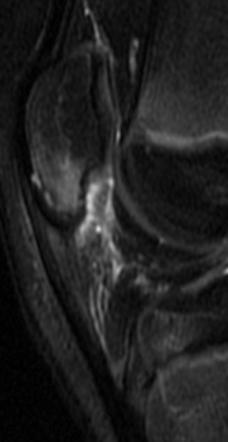 Sinding-Larsen-Johansson disease | Radiology Reference Article