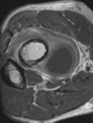 Radial tunnel syndrome | Radiology Reference Article | Radiopaedia.org