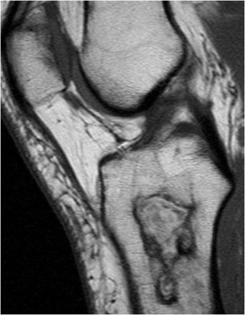 Enchondroma | Radiology Reference Article | Radiopaedia.org