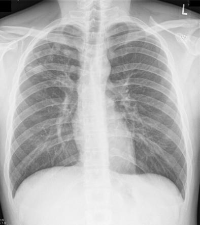 Pulmonary tuberculosis | Radiology Case | Radiopaedia.org