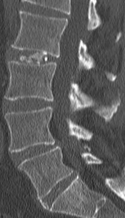 Intervertebral disc calcification | Radiology Case | Radiopaedia.org