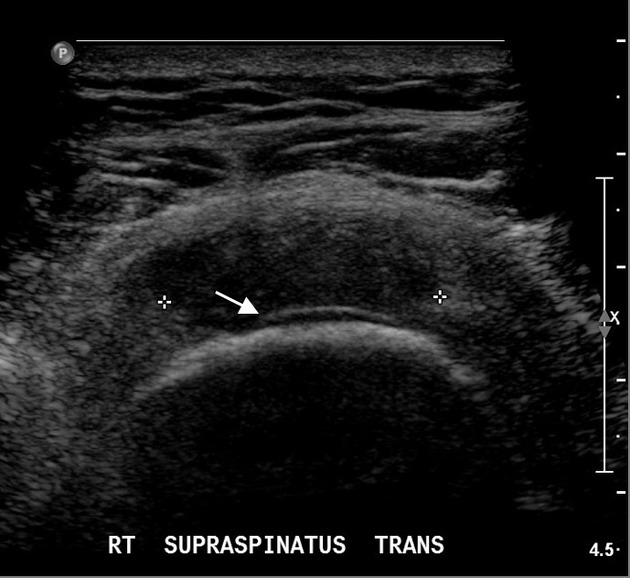 Ultrasound of the shoulder | Radiology Reference Article | Radiopaedia.org