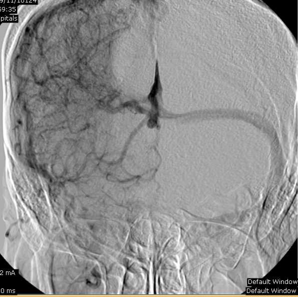 Developmental Venous Anomaly Image