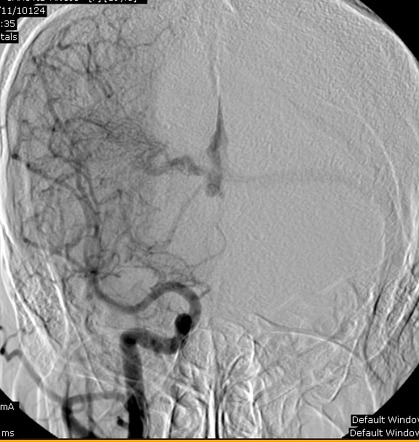 Cerebrovascular malformations | Radiology Reference Article ...