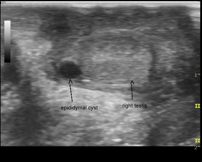 Encysted Hydrocele Of The Spermatic Cord Image