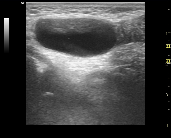 Encysted Hydrocele Of The Spermatic Cord Image