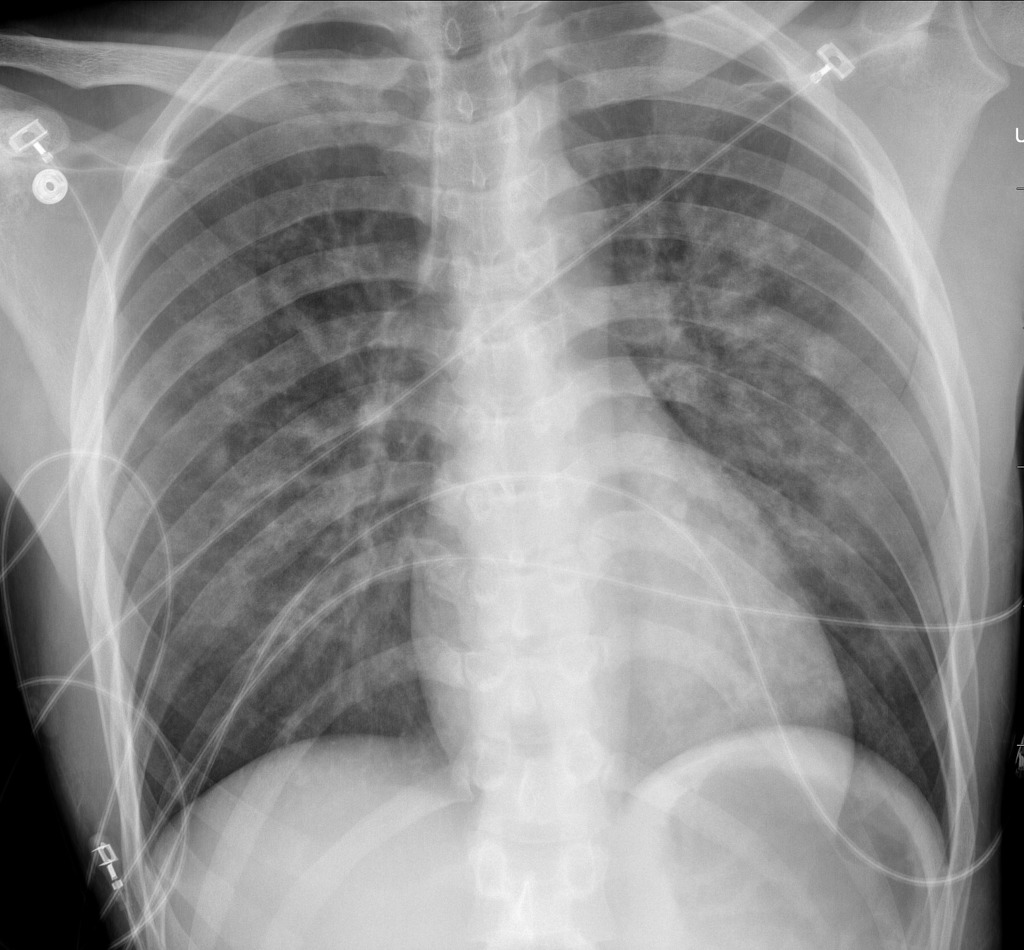 pulmonary edema chest x ray