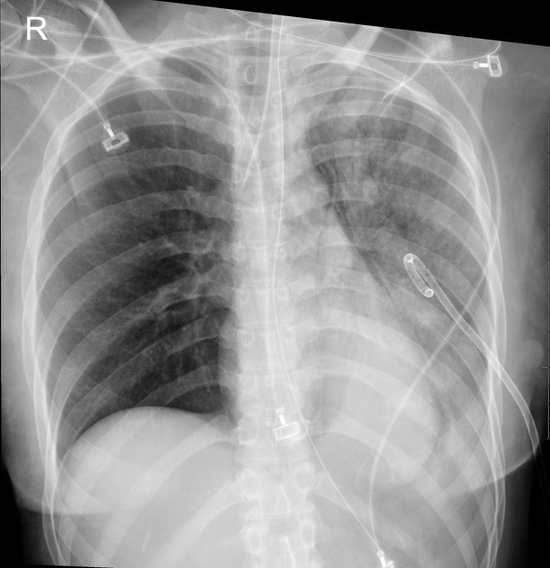 Hemithorax white-out (differential)