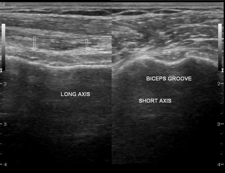 Rotator cuff tear and muscle atrophy | Radiology Case | Radiopaedia.org