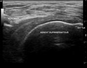 Rotator cuff tear | Radiology Reference Article | Radiopaedia.org