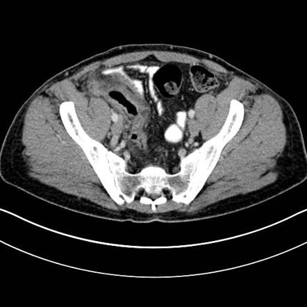 Appendicitis | Radiology Case | Radiopaedia.org