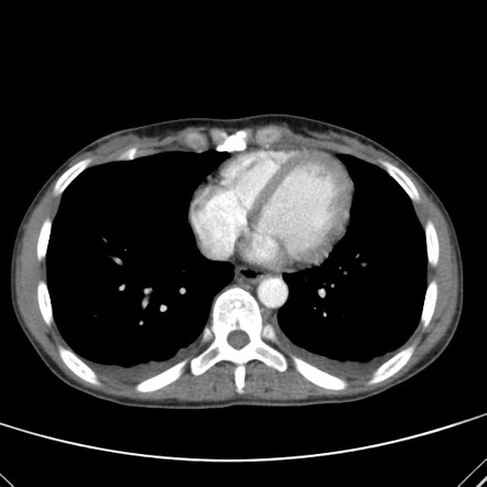 Ovarian Metastasis From Colorectal Adenocarcinoma 