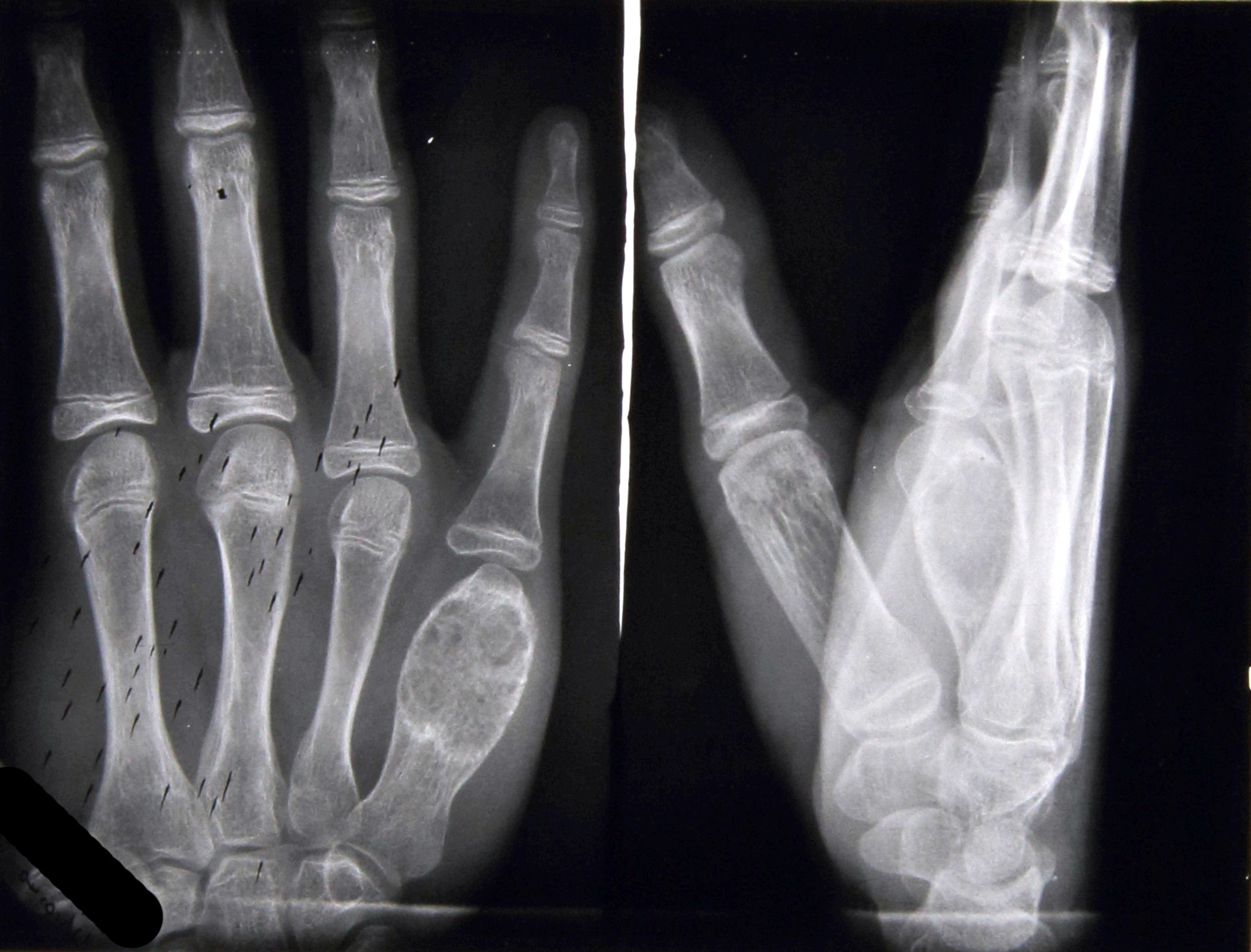 Tuberculous Dactylitis - Historic Case From 1940 | Image | Radiopaedia.org