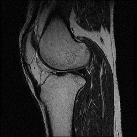 Osgood-Schlatter disease | Image | Radiopaedia.org