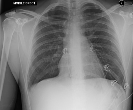 Cervical ribs | Radiology Case | Radiopaedia.org