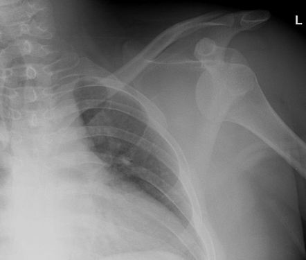 Bilateral Anterior Shoulder Dislocations Post Seizure 