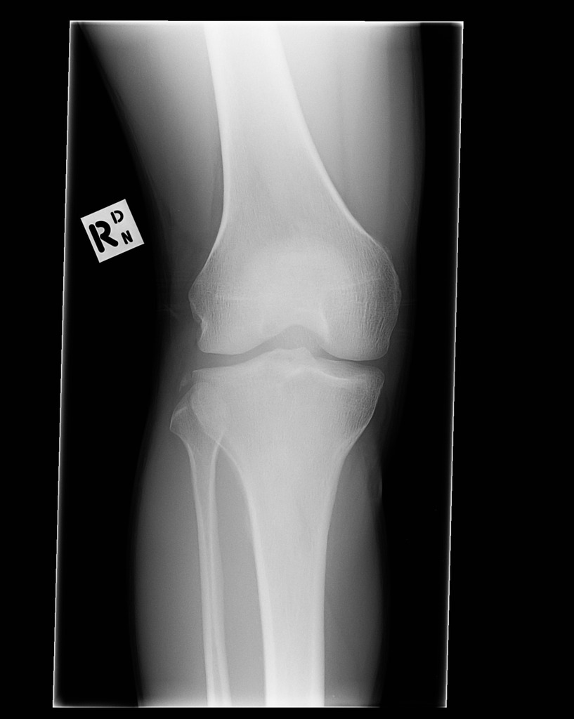 Segond Fracture With Anterior Cruciate Ligament And Lateral