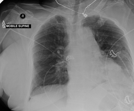 Traumatic diaphragm rupture and abdominal wall hernia | Radiology Case ...