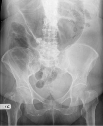 bowel obstruction stricture radiation radiopaedia frontal point transition ct