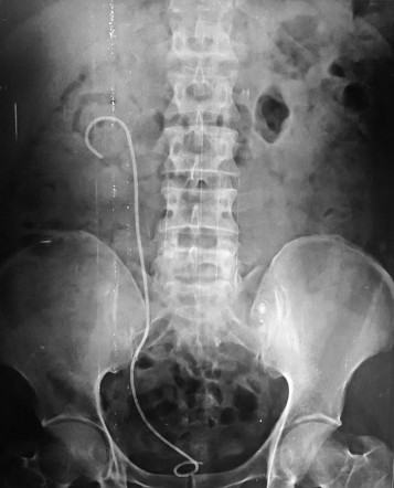 Nephroureteral stent | Radiology Case | Radiopaedia.org