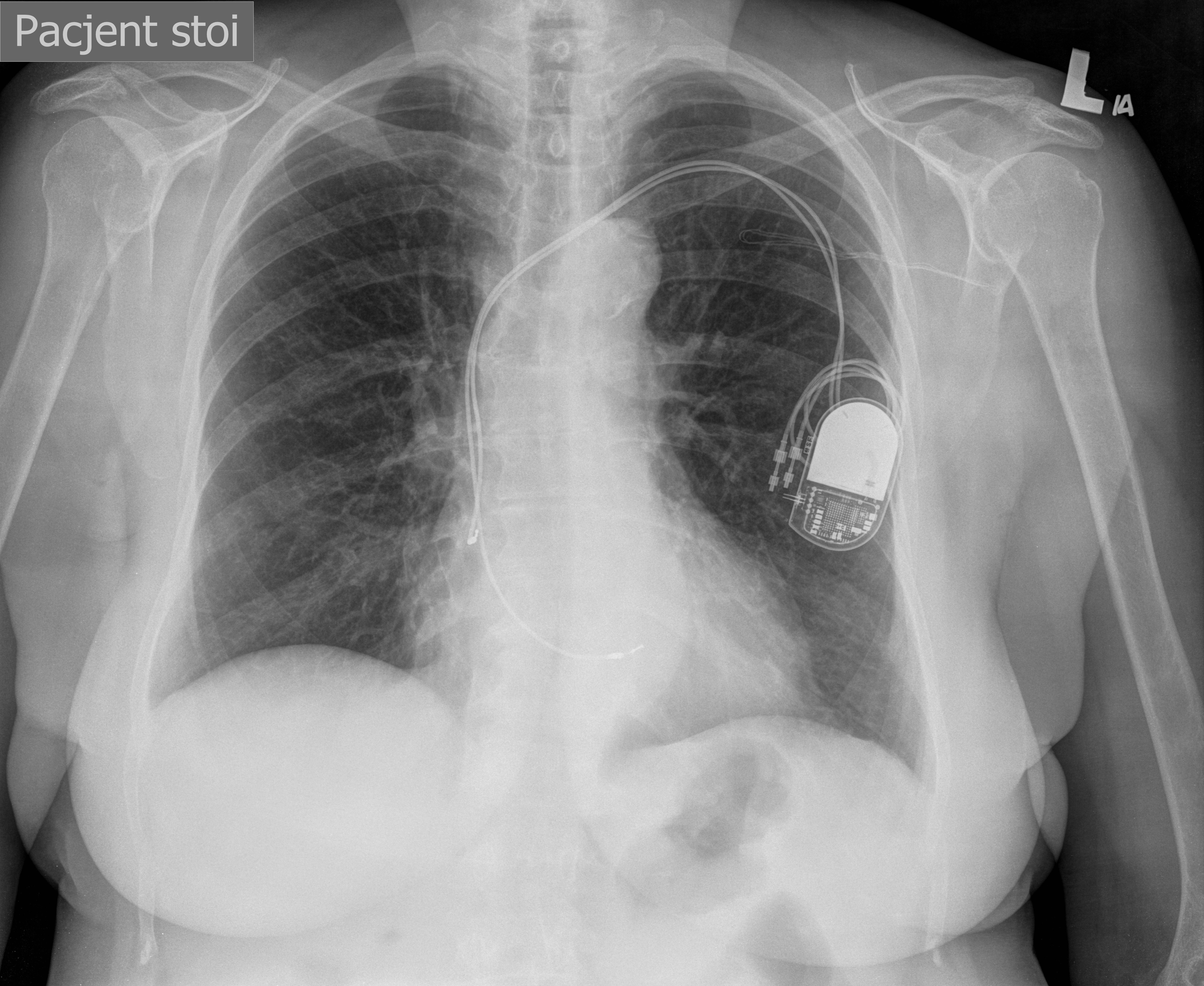 Pacemaker Chest X Ray