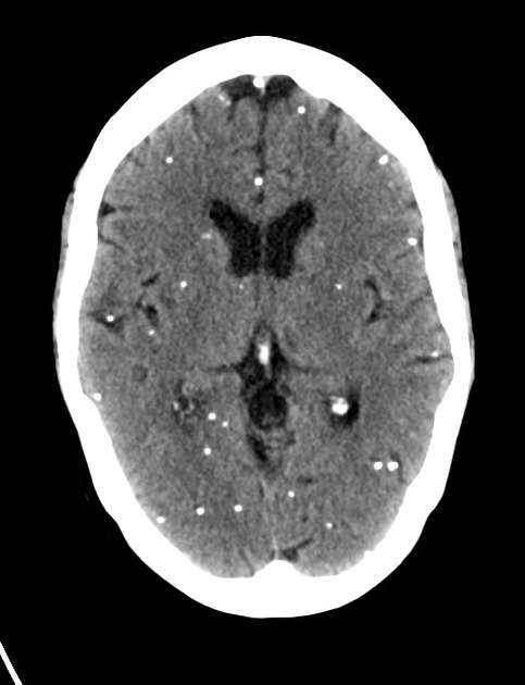 neurocysticercosis