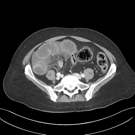 Closed loop obstruction | Radiology Reference Article | Radiopaedia.org